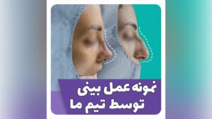 عمل بینی استخونی