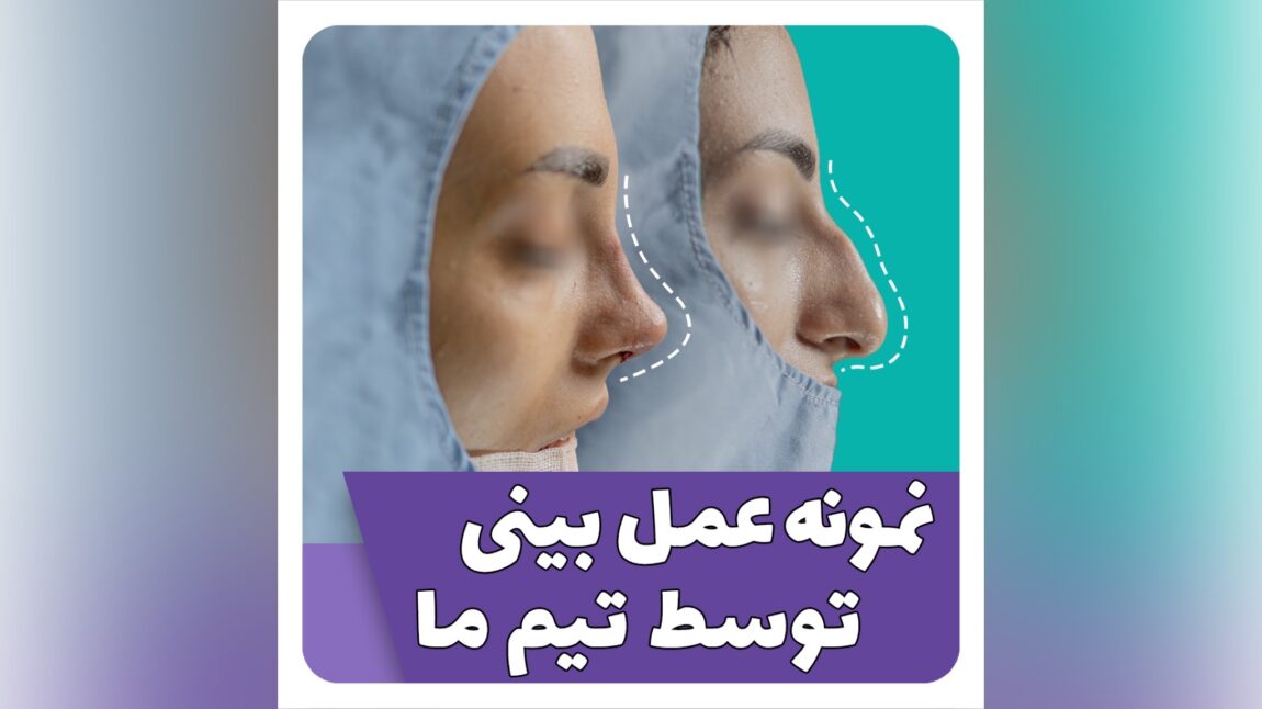 عمل بینی استخونی